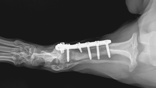 Obraz radiologiczny kończyny miednicznej prawej po 8 tygodniach od osteotomii (4 tygodnie po osteotomii kończyny lewej)