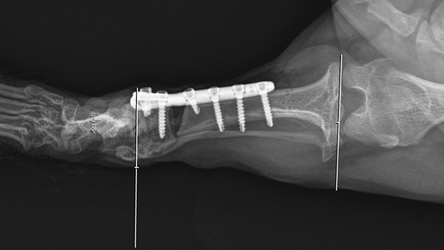 Obraz radiologiczny kości piszczelowej prawej po zabiegu osteotomii